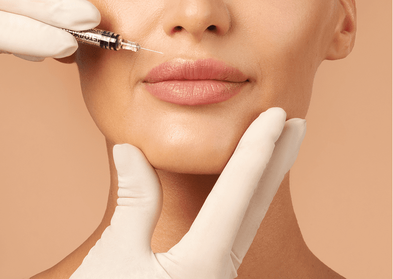 Lip enhancement procedure with syringe